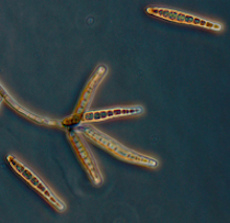 Exserohilum rostrum Fungal Infection from New England Compounding Company