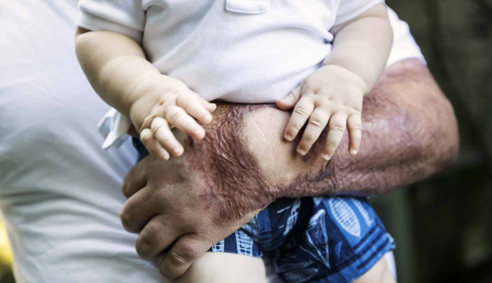 Burn Injury Lawsuit FAQ by Lawyers Pritzker and Hageman