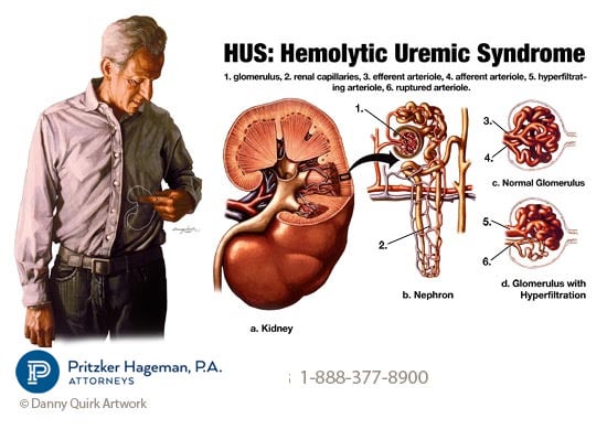 Hemolytic Uremic Syndrome HUS Information