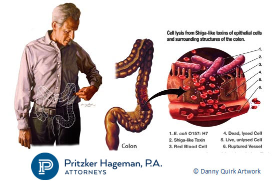E. coli Symptoms