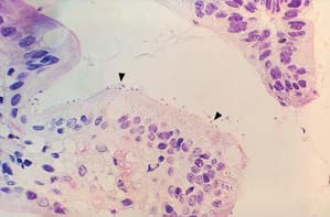 Cryptosporidiosis