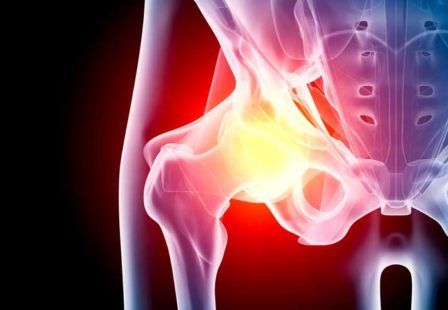 Hip Implant Lawsuit