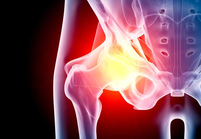 Hip Implant Lawsuit