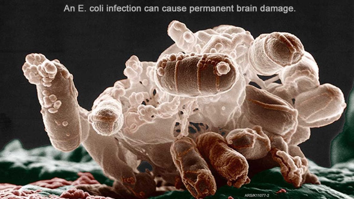 E. coli Can Cause Brain Damage