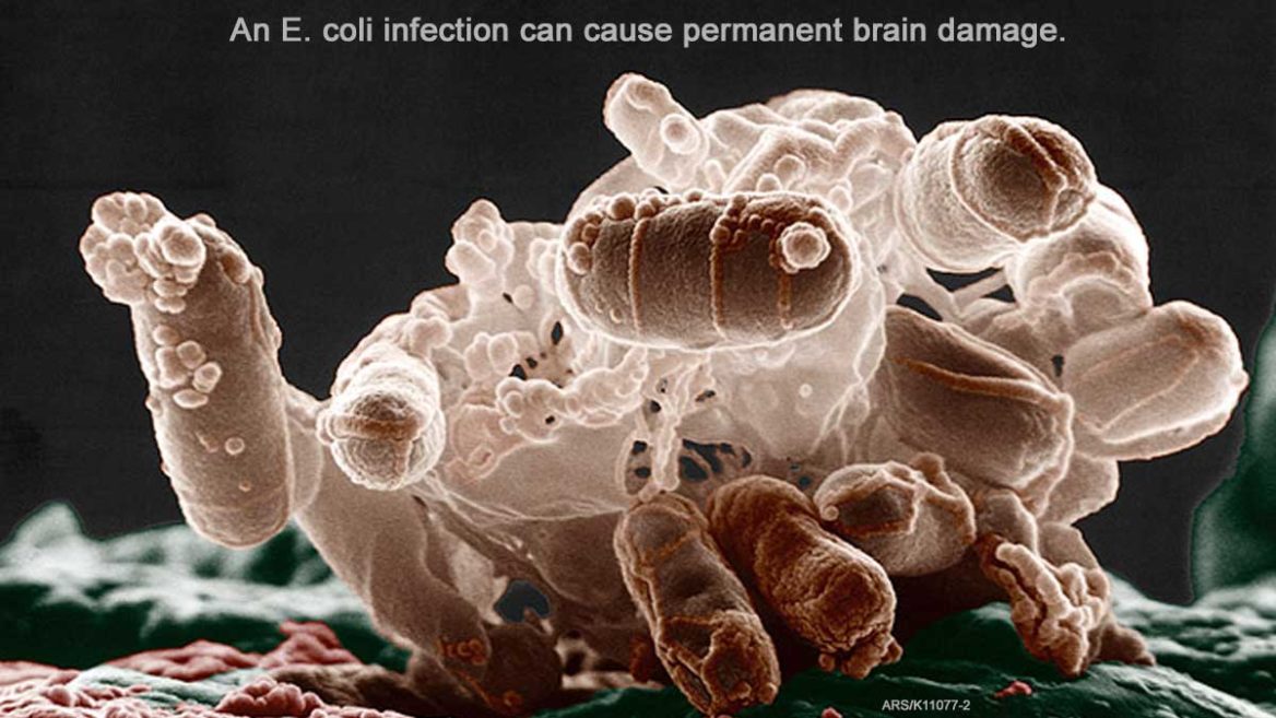 E. coli Can Cause Brain Damage