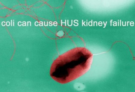 E. coli HUS Kidney Failure