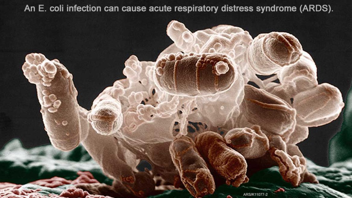 E. coli and Respiratory Distress Syndrome ARDS