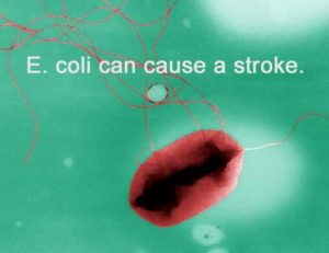 E. coli Stroke