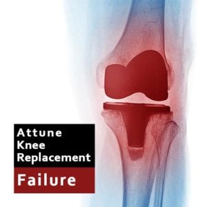 X Ray image of Attune knee replacement