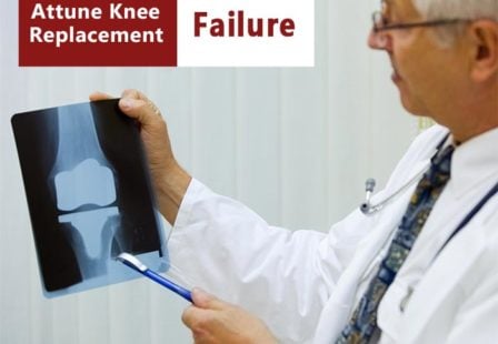 Attune knee replacement failure