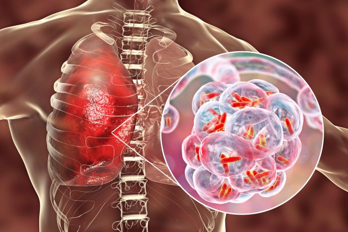 legionnaires disease lawyer- graphic illustration of legionella pneumonia