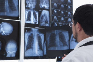 Lung Doctor looking at Juul user lungs, heart and brain