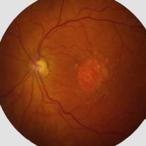 retinal damage - elmiron