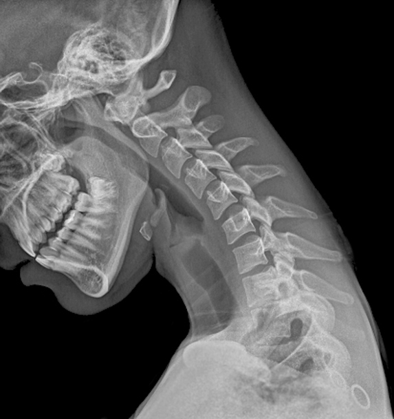 Image of Spine - Radio Frequency Ablation