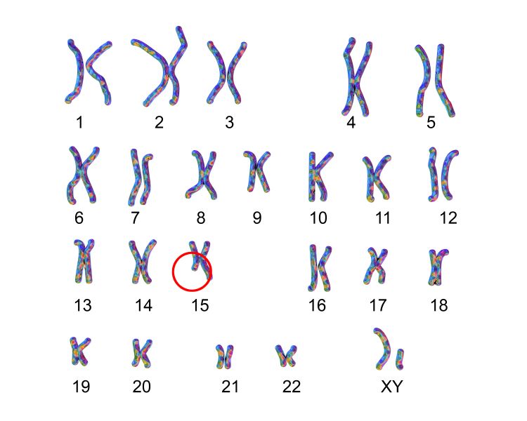 angelman syndrome chromosome pattern