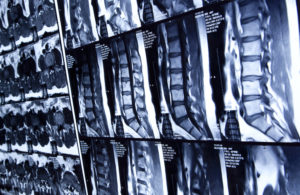 MRI scan of human lumbar spine infection