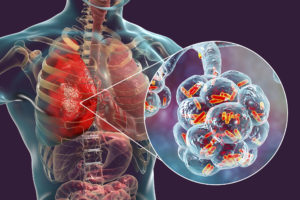 Legionella pneumonia infecting lung tissue