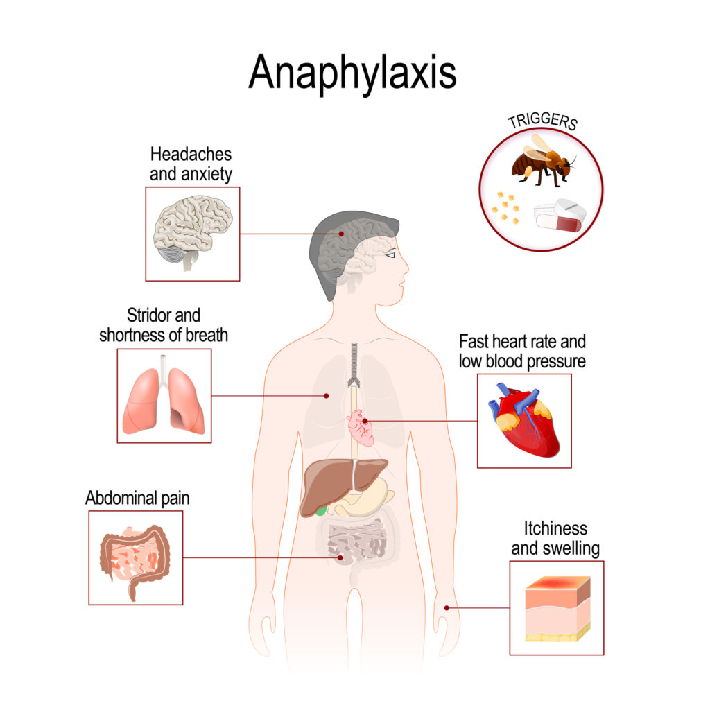 Anaphylaxis organs involvement