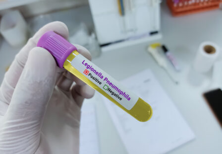 Scientist holding a urine sample for Legionella antigen test